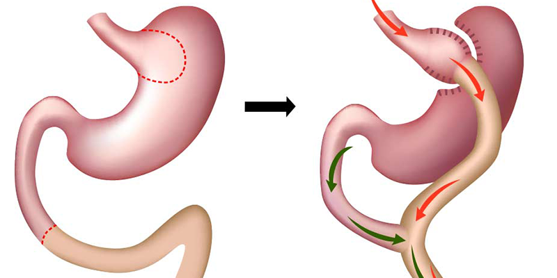 Gastric Bypass